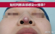 隆鼻感染初期症状(隆鼻远期感染)