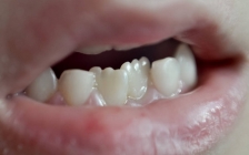 牙龈萎缩是什么病(萎缩病牙龈是白色的吗)