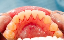 牙龈萎缩是什么原因造成的(萎缩牙龈怎么办)