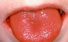 草莓舌(舌草莓中医)