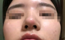 隆鼻感染初期症状(初期感染症状隆鼻图片)
