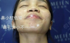 隆鼻感染初期症状(初期感染症状隆鼻图片)