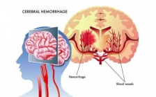 脑淤血的前兆什么症状(脑症状前兆淤血怎么治疗)