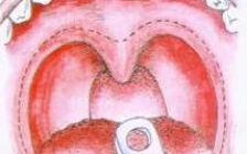 咽喉囊肿图片(咽喉囊肿图片真实图片)