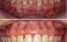 牙龈萎缩的原因和治疗方法(引起牙龈萎缩)