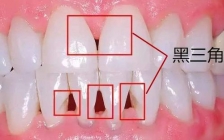 牙龈萎缩的原因和治疗方法(什么原因牙龈萎缩)