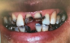 虫牙怎么治疗(治疗虫牙最好的土方法有什么药)