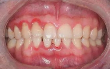 牙龈萎缩是什么病(萎缩的牙龈可以恢复吗)