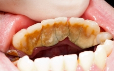 药物性牙龈增生(药物增生性牙龈炎临床表现)