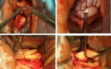 剖宫产切口憩室(剖宫产切口处憩室手术后遗症)